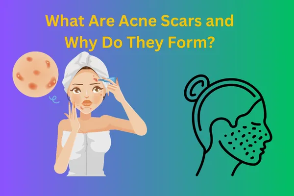 Pimple Marks Removal Cream