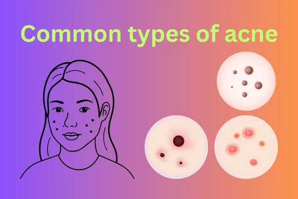 Face Cream for Pimples: The Ultimate Guide to Clearer Skin