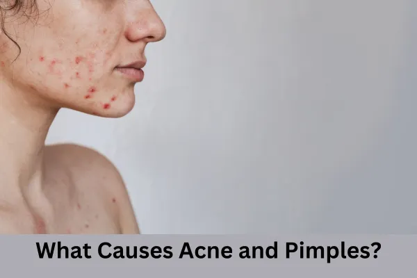 How to Remove Pimples Naturally and Permanently