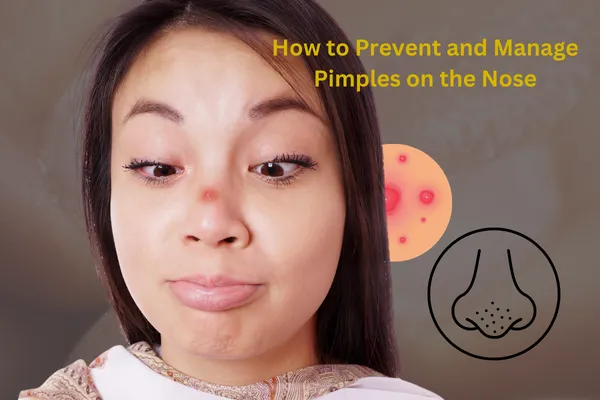 Bid Goodbye to Pimples on the Nose with These Tried-and-Tested Tips