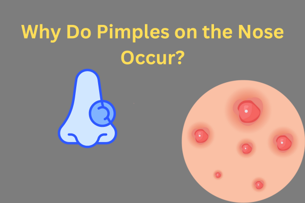 Bid Goodbye to Pimples on the Nose with These Tried-and-Tested Tips