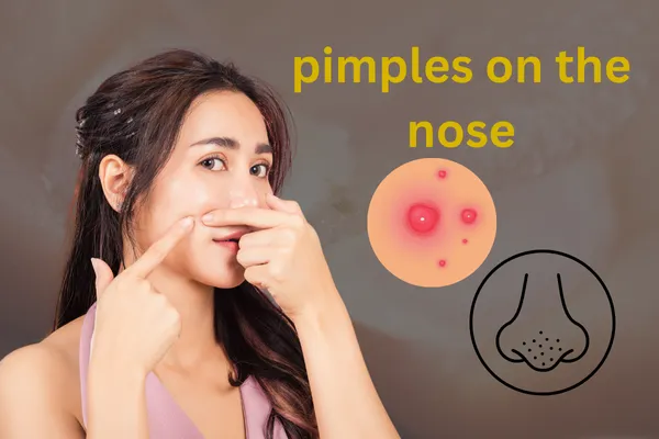 Bid Goodbye to Pimples on the Nose with These Tried-and-Tested Tips