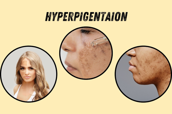 Skin Brightening Treatments – The Complete Guide to a Radiant Glow