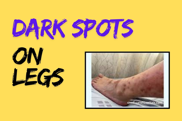 How to Get Rid of Dark Spots on Legs: Your Complete Guide
