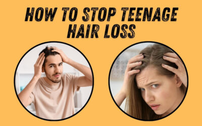 How to Stop Teenage Hair Loss