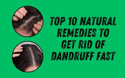 Top 10 Natural Remedies to Get Rid of Dandruff Fast