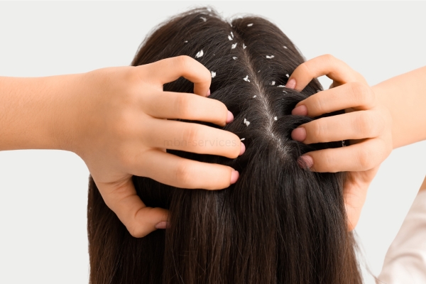 Top 10 Natural Remedies to Get Rid of Dandruff Fast
